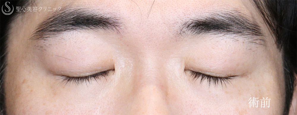 【40代男性・凛々しい目元に】眼瞼下垂＋眉下リフト（1年8ヶ月後） Before 