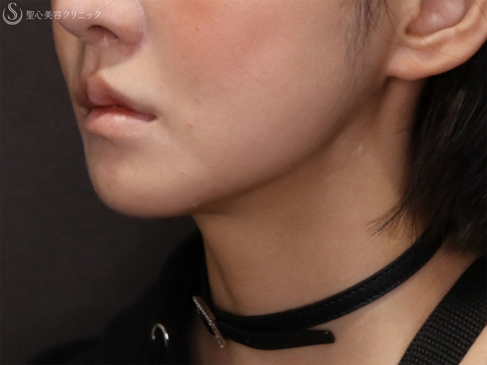 【20代女性・フェイスラインと顎下のたるみ治療】顎下脂肪吸引注射＋顎下の糸リフト（1ヶ月後） After 