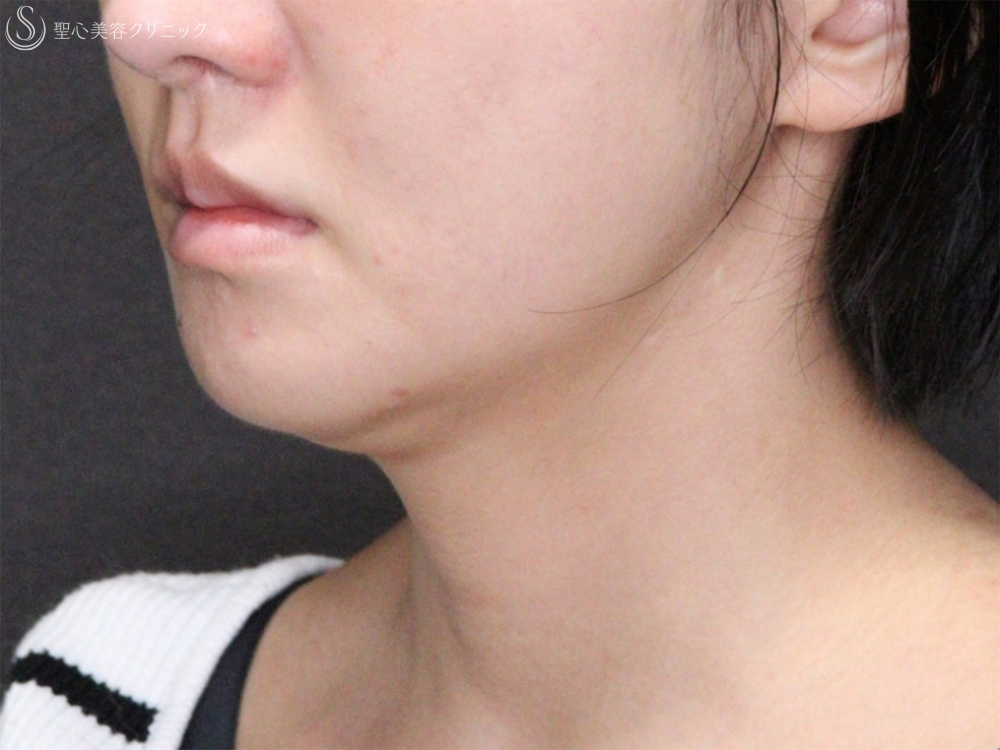 【20代女性・フェイスラインと顎下のたるみ治療】顎下脂肪吸引注射＋顎下の糸リフト（1ヶ月後） Before 