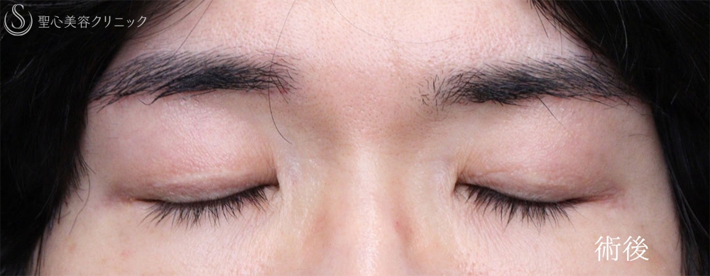 【40代男性・凛々しい目元に】眼瞼下垂＋眉下リフト（1年8ヶ月後） After 