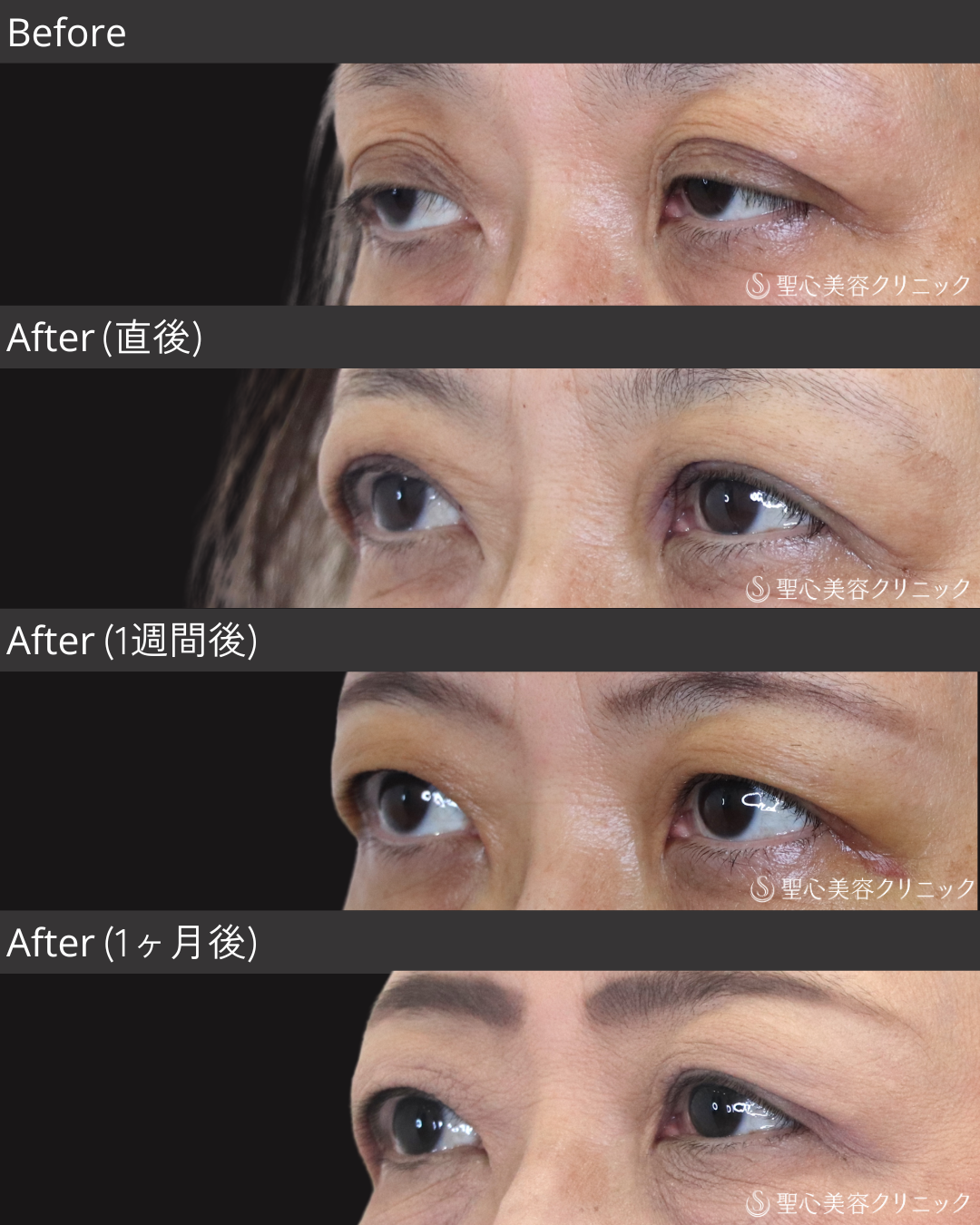 【60代女性・自然な仕上がり】眼瞼下垂（1ヶ月後） After 