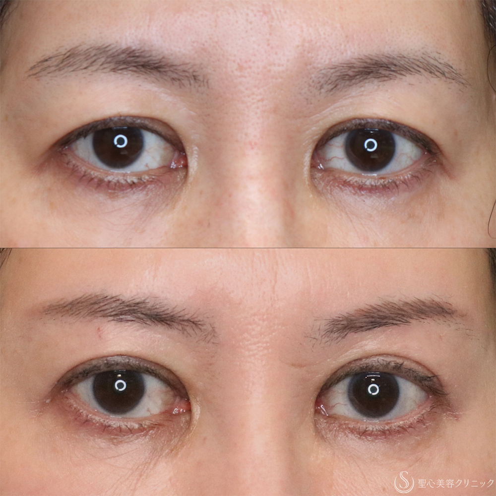 【50代女性・まぶたすっきり】眉下切開法（眉下リフト）（3年後） After 名古屋・まぶたのタルミ取り・二重・ぱっちり二重・眉下切開