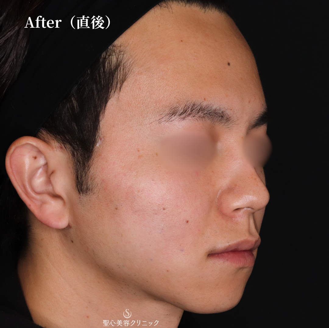 【30代男性・糸リフトで自然とほうれい線の改善】アンカーPlus（直後） After 