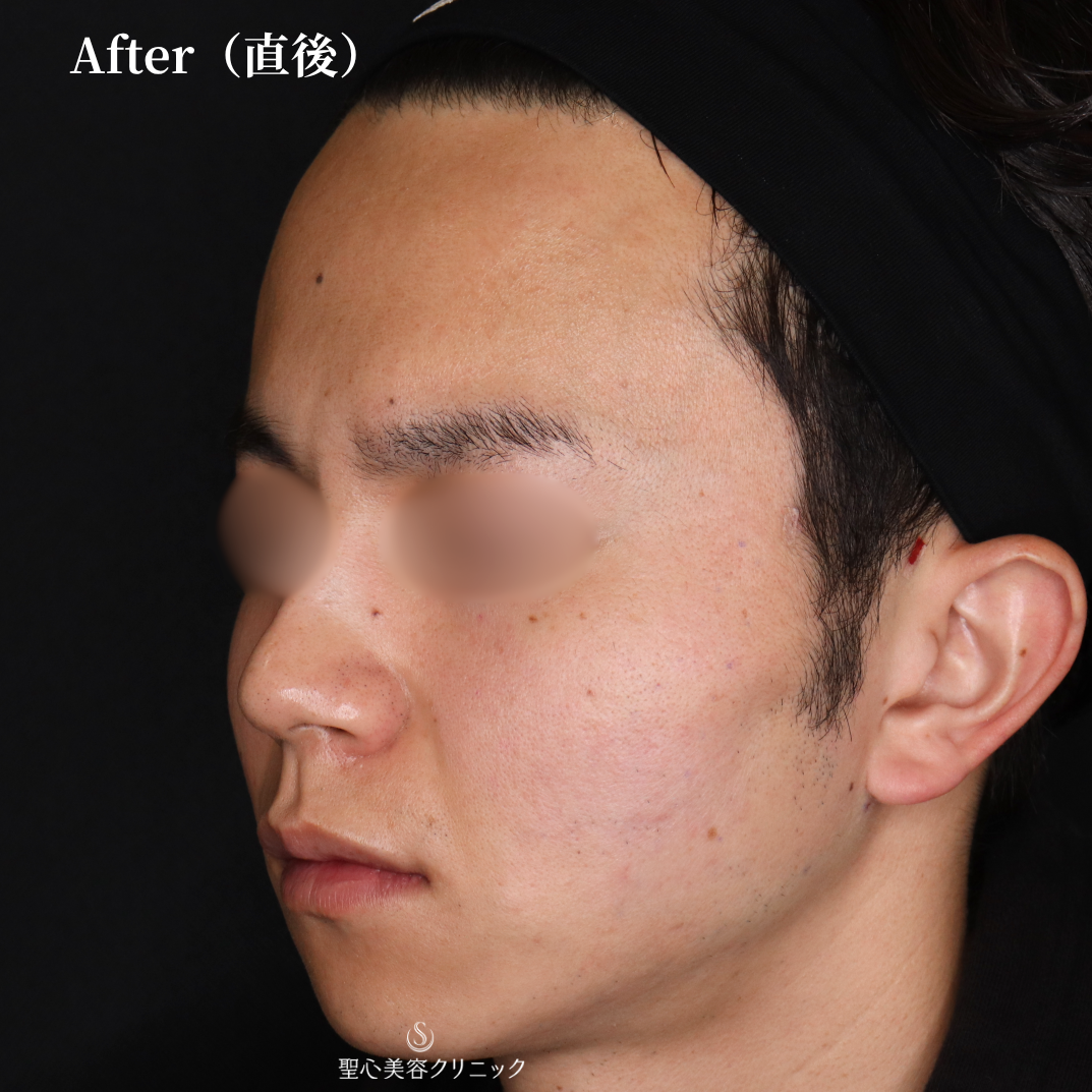 【30代男性・糸リフトで自然とほうれい線の改善】アンカーPlus（直後） After 