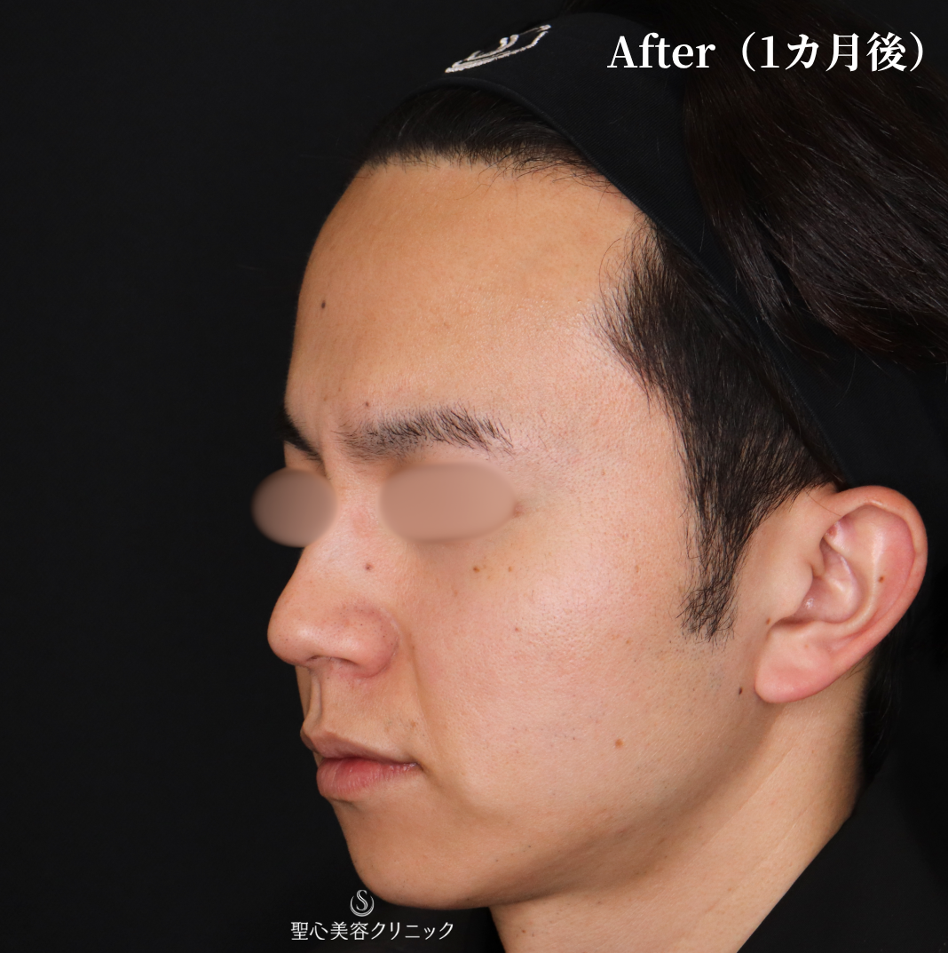 【30代男性・糸リフトで自然とほうれい線の改善】アンカーPlus（直後） After 