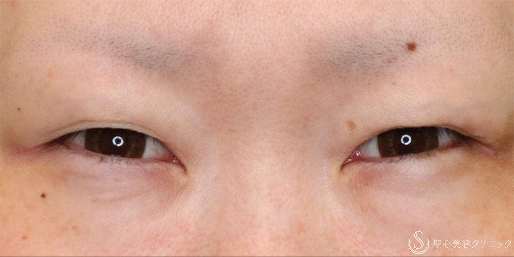 【30代女性・たれ目に】目尻切開法＋グラマラスライン（たれ目）形成切開法（11ヶ月後） Before 名古屋・たれ目・目尻切開・グラマラスライン
