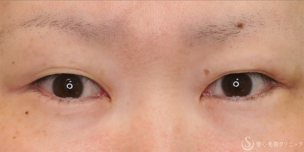 【30代女性・たれ目に】目尻切開法＋グラマラスライン（たれ目）形成切開法（11ヶ月後） After 名古屋・たれ目・目尻切開・グラマラスライン