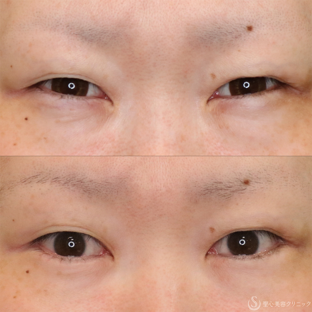 【30代女性・たれ目に】目尻切開法＋グラマラスライン（たれ目）形成切開法（11ヶ月後） After 名古屋・たれ目・目尻切開・グラマラスライン