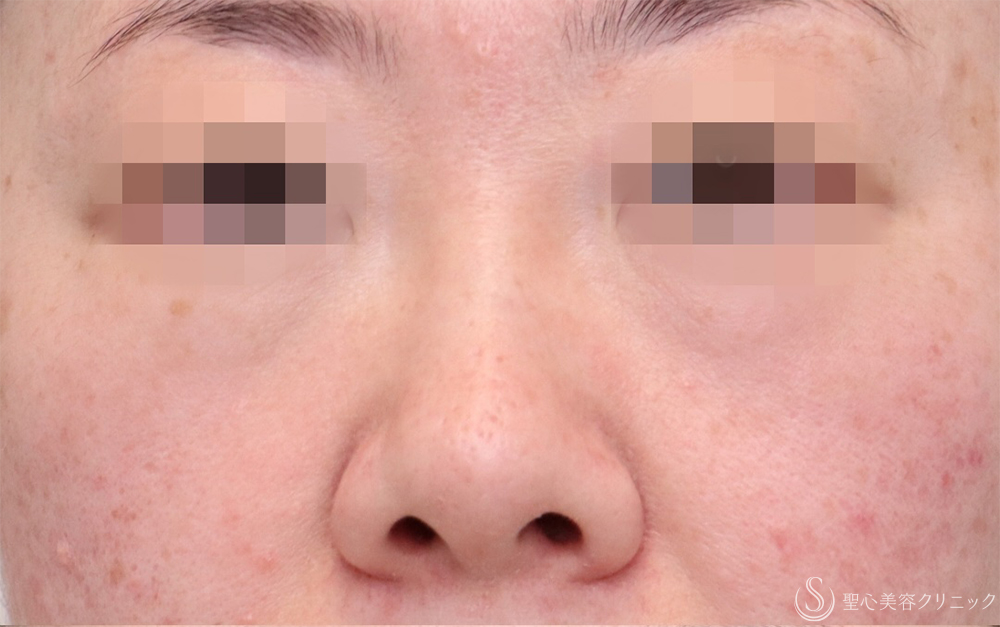 【40代女性・自然に鼻筋を整える】鼻のプロテーゼ＋耳介軟骨移植（1ヶ月後） Before 