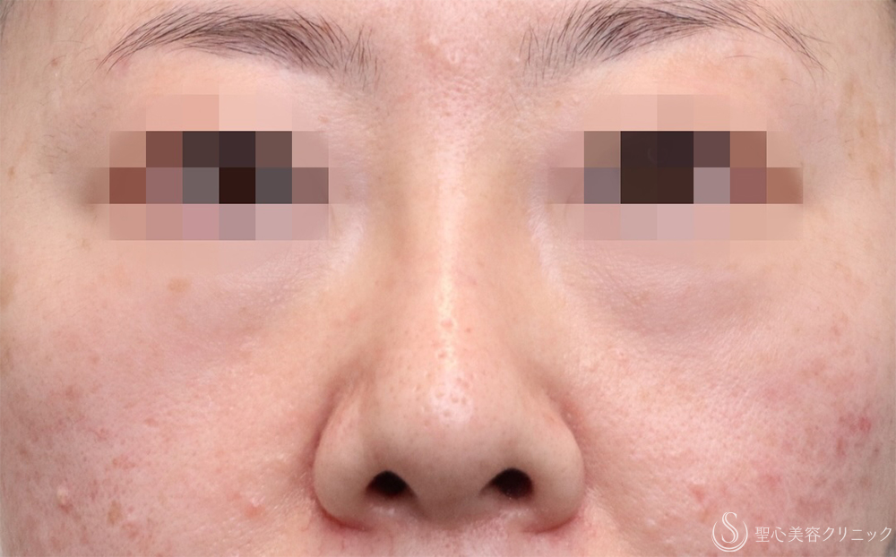 【40代女性・自然に鼻筋を整える】鼻のプロテーゼ＋耳介軟骨移植（1ヶ月後） After 