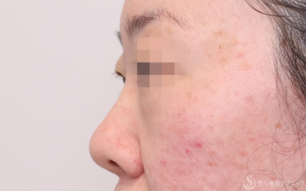 【40代女性・自然に鼻筋を整える】鼻のプロテーゼ＋耳介軟骨移植（1ヶ月後） Before 