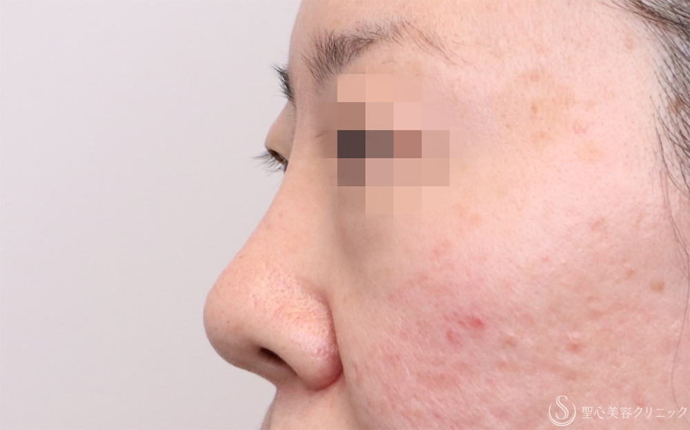 【40代女性・自然に鼻筋を整える】鼻のプロテーゼ＋耳介軟骨移植（1ヶ月後） After 