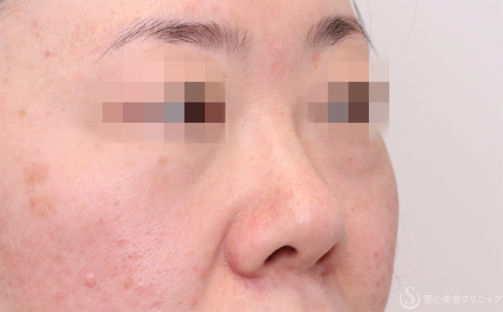 【40代女性・自然に鼻筋を整える】鼻のプロテーゼ＋耳介軟骨移植（1ヶ月後） Before 