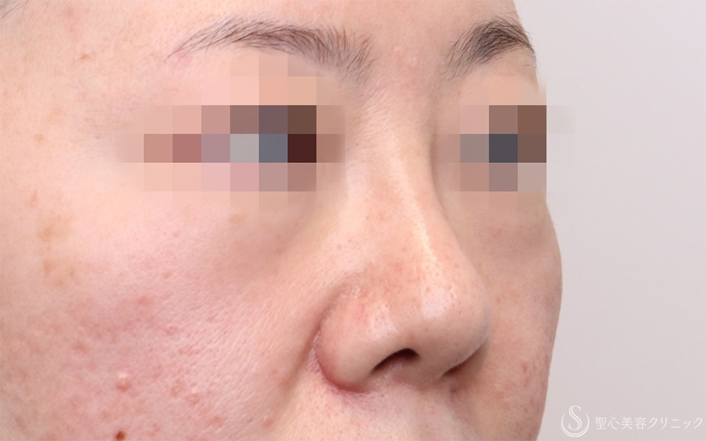 【40代女性・自然に鼻筋を整える】鼻のプロテーゼ＋耳介軟骨移植（1ヶ月後） After 