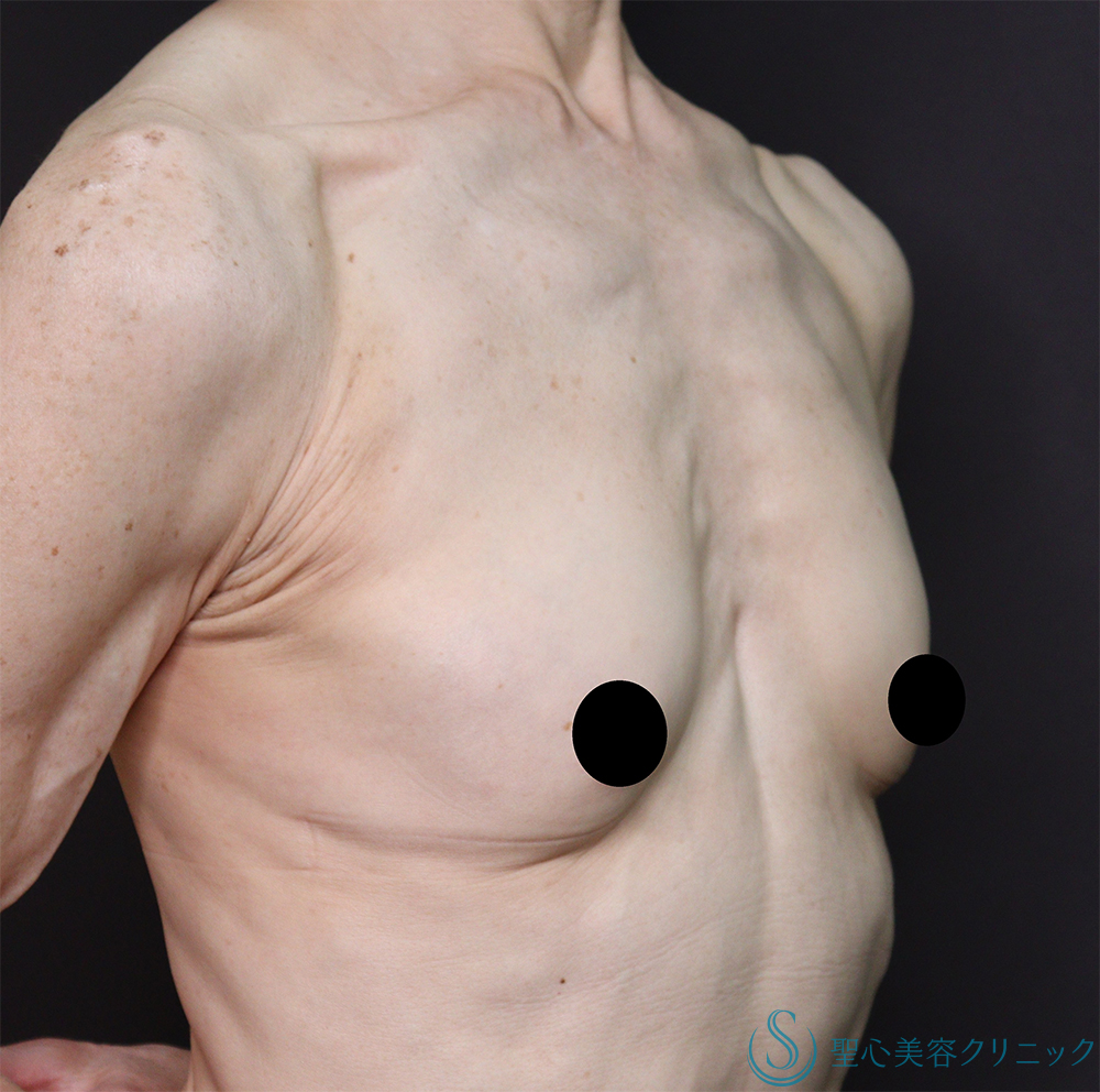 【60代女性・豊胸】ピュアグラフト豊胸術（3ヶ月後） After 