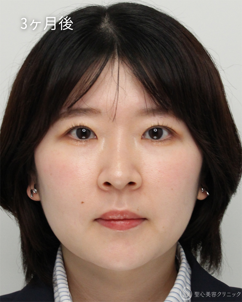 【20代女性・取れない華やかな二重に】二重切開術（3ヶ月後） After 