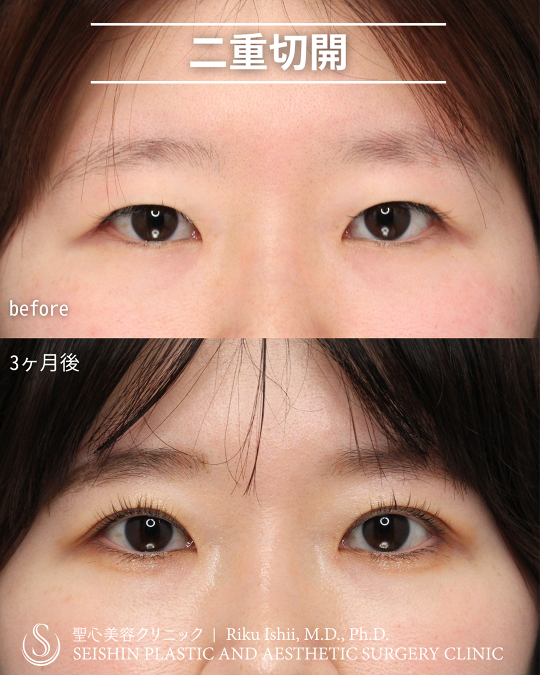 【20代女性・取れない華やかな二重に】二重切開術（3ヶ月後） After 