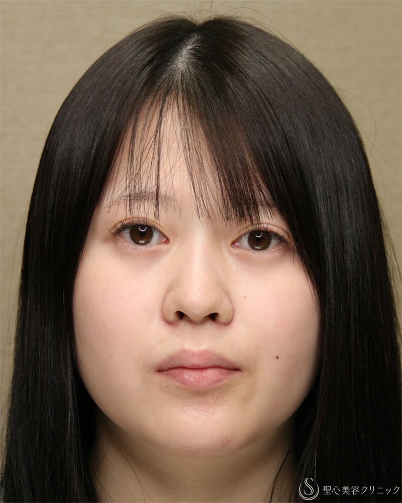 【20代女性・小鼻のはりを抑える】小鼻縮小術・内外側法（2ヶ月後） Before 
