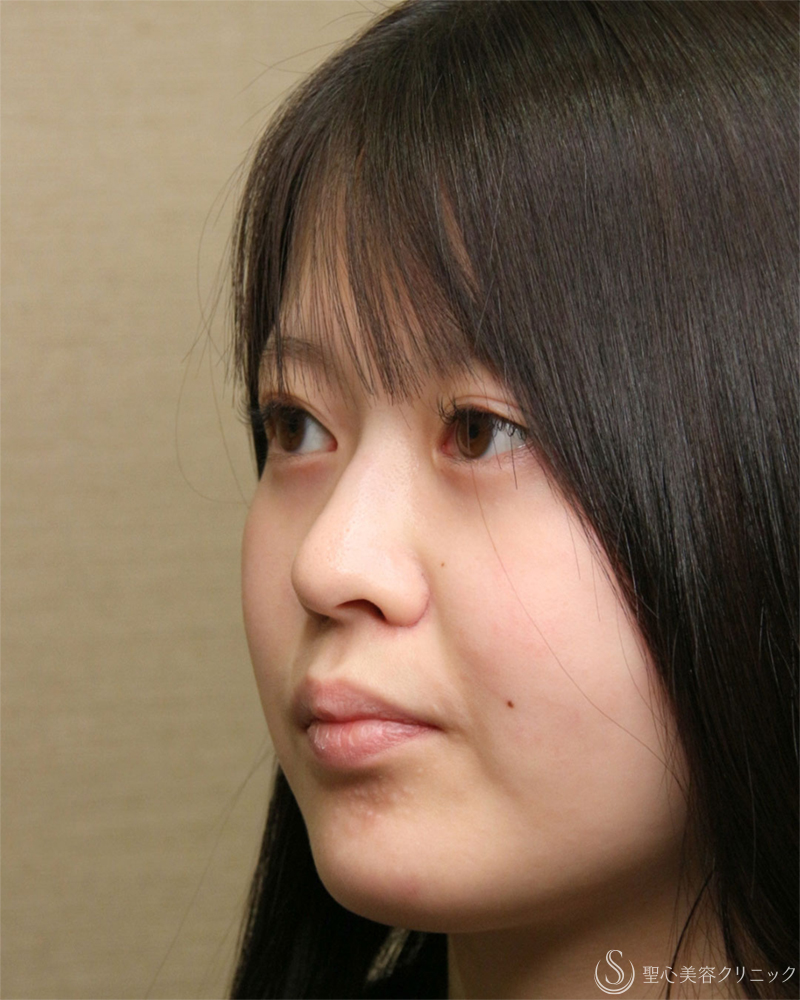 【20代女性・小鼻のはりを抑える】小鼻縮小術・内外側法（2ヶ月後） Before 