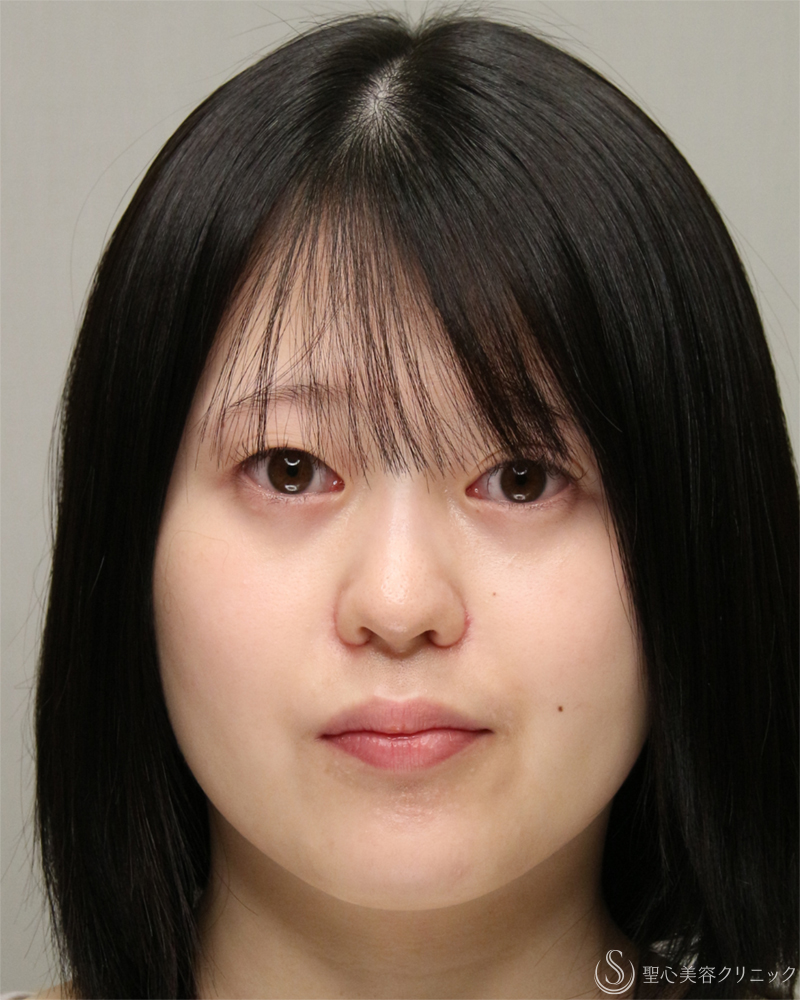 【20代女性・小鼻のはりを抑える】小鼻縮小術・内外側法（2ヶ月後） After 