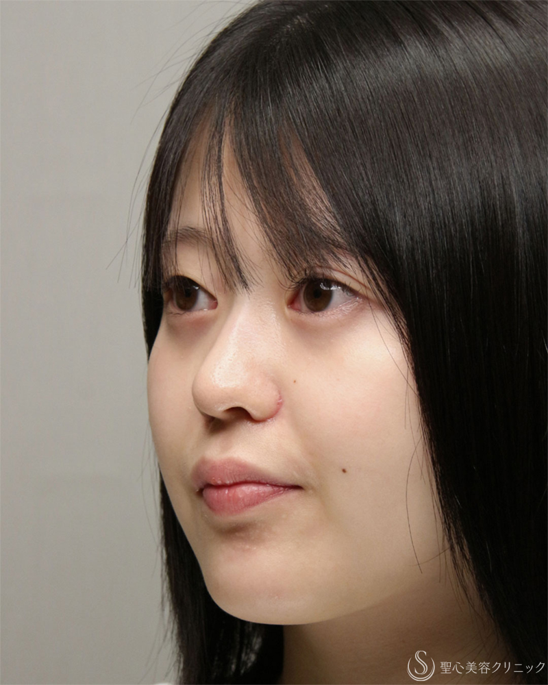 【20代女性・小鼻のはりを抑える】小鼻縮小術・内外側法（2ヶ月後） After 