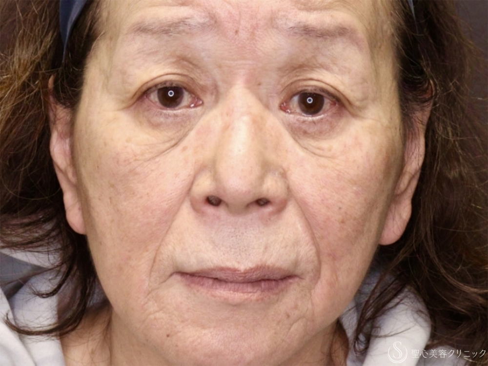 【70代女性・目の下のたるみ改善】他院結膜側脱脂後の目の下のたるみ除去（3ヶ月後） Before 