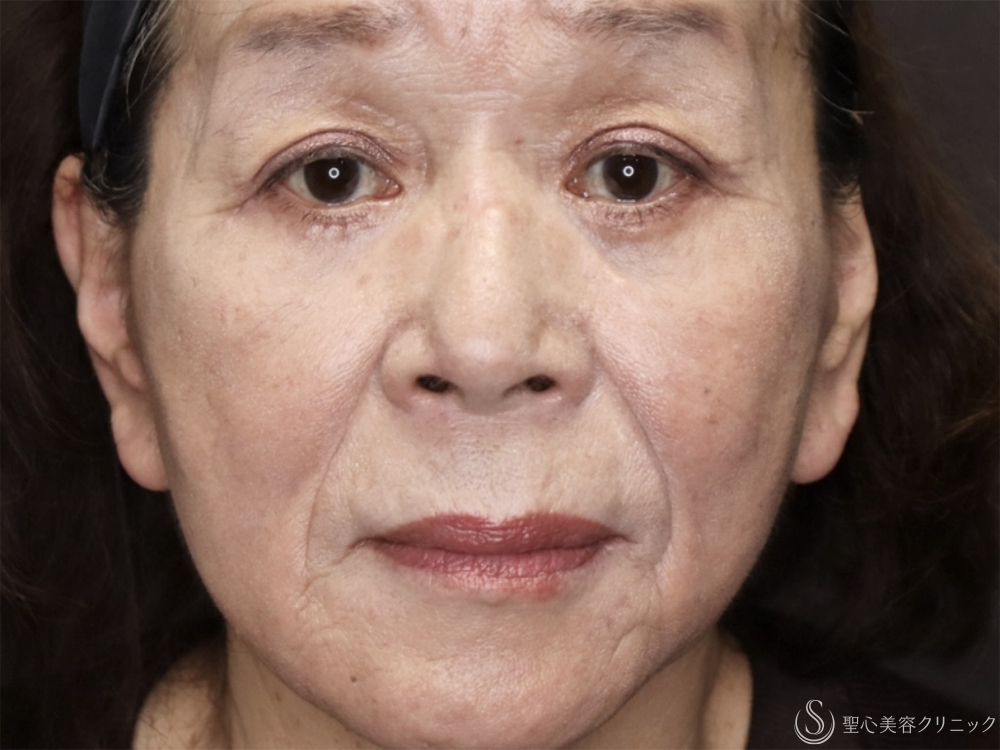 【70代女性・目の下のたるみ改善】他院結膜側脱脂後の目の下のたるみ除去（3ヶ月後） After 