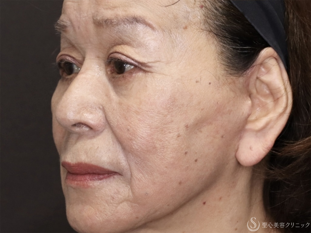 【70代女性・目の下のたるみ改善】他院結膜側脱脂後の目の下のたるみ除去（3ヶ月後） After 