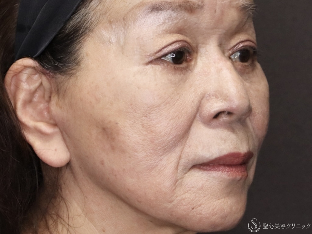 【70代女性・目の下のたるみ改善】他院結膜側脱脂後の目の下のたるみ除去（3ヶ月後） After 