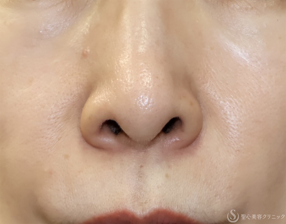 【40代女性・鼻の穴が見えるのが気になる】鼻孔縁下降術（1ヶ月後） Before 