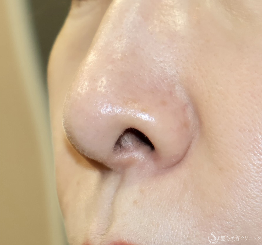 【40代女性・鼻の穴が見えるのが気になる】鼻孔縁下降術（1ヶ月後） Before 
