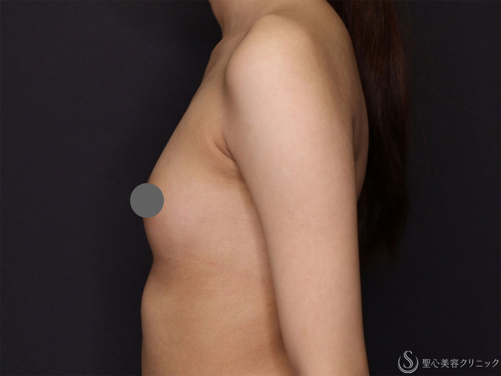 【20代女性・体型にあった自然なサイズアップ】バッグによる豊胸術（MotivaErgonomix2 180cc）（3ヶ月後） Before 