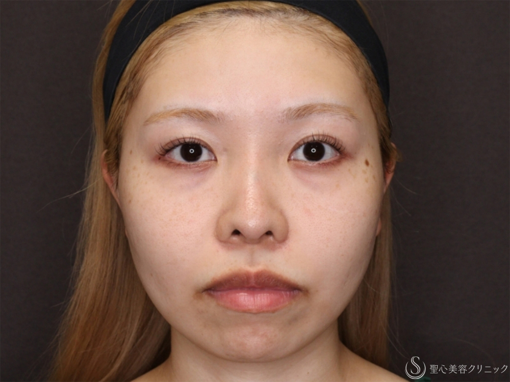 【20代女性・自然な変化で小顔に】小鼻縮小＋顎プロテーゼ＋顎下脂肪吸引注射（8ヶ月後） Before 