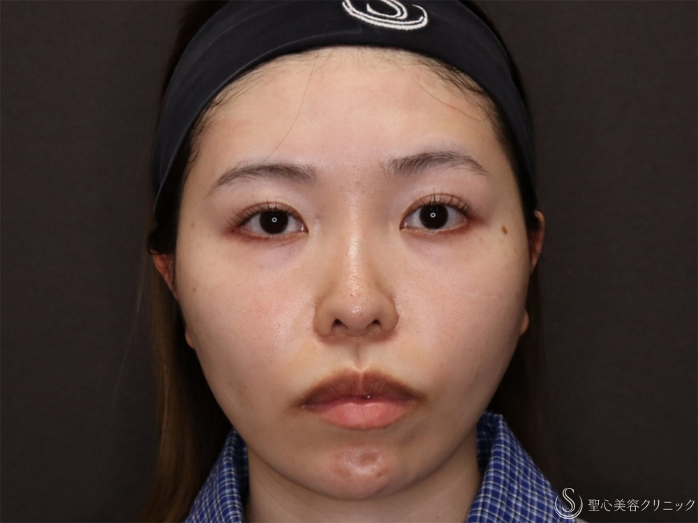 【20代女性・自然な変化で小顔に】小鼻縮小＋顎プロテーゼ＋顎下脂肪吸引注射（8ヶ月後） After 