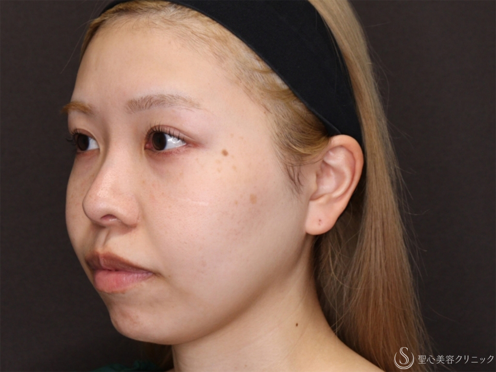 【20代女性・自然な変化で小顔に】小鼻縮小＋顎プロテーゼ＋顎下脂肪吸引注射（8ヶ月後） Before 