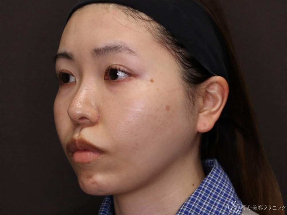 【20代女性・自然な変化で小顔に】小鼻縮小＋顎プロテーゼ＋顎下脂肪吸引注射（8ヶ月後） After 