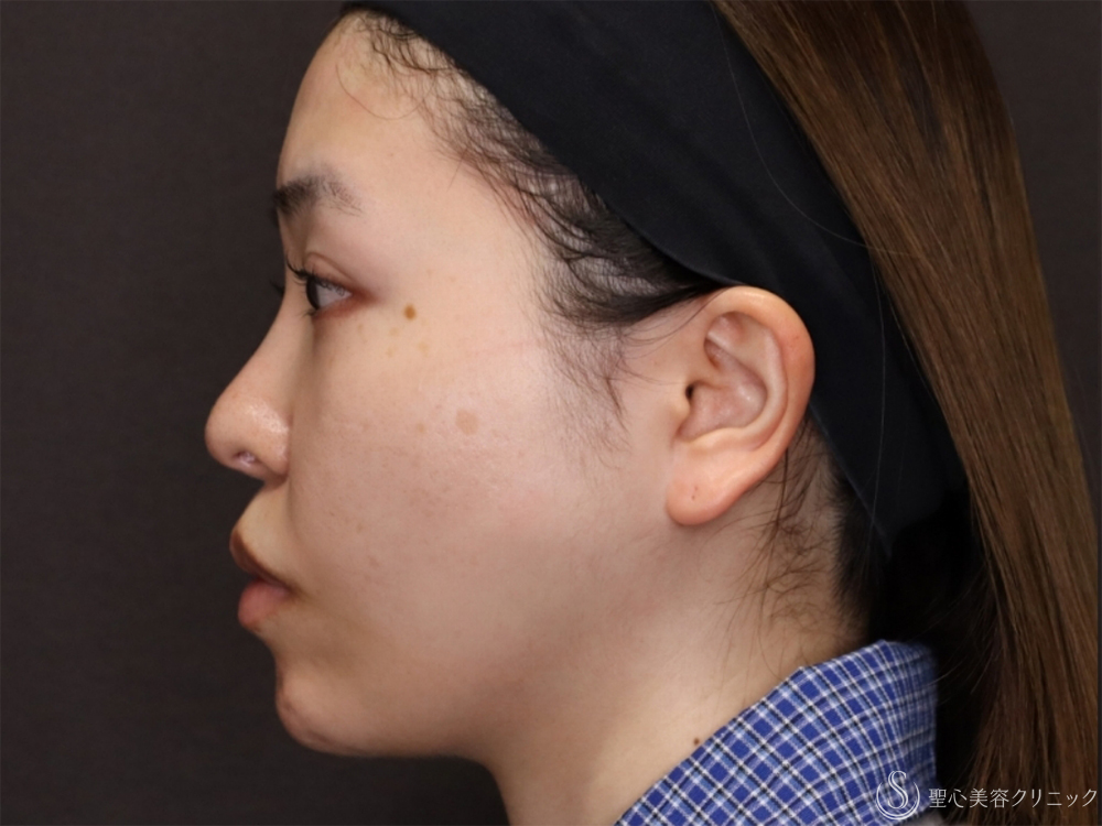 【20代女性・自然な変化で小顔に】小鼻縮小＋顎プロテーゼ＋顎下脂肪吸引注射（8ヶ月後） After 