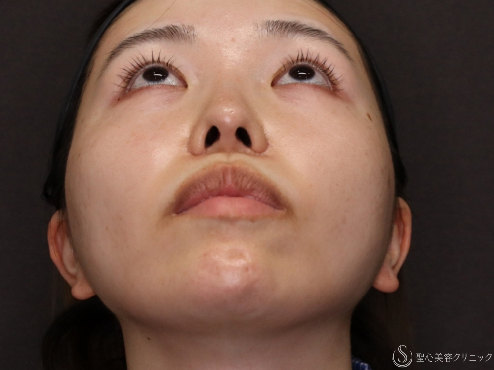 【20代女性・自然な変化で小顔に】小鼻縮小＋顎プロテーゼ＋顎下脂肪吸引注射（8ヶ月後） After 