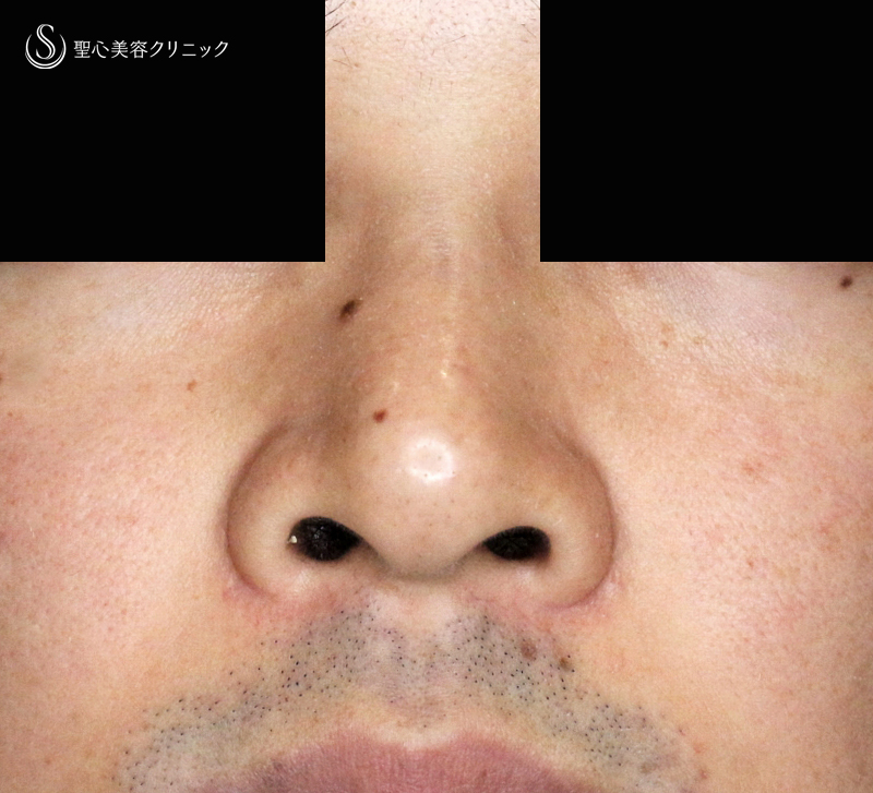 【20代男性・外側切開なしで「忘れ鼻」】小鼻縮小術+α法「Ver.7.5」単独（術直後〜7ヶ月後） Before 