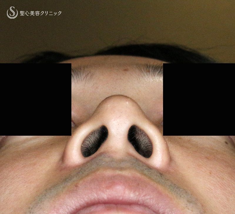 【20代男性・外側切開なしで「忘れ鼻」】小鼻縮小術+α法「Ver.7.5」単独（術直後〜7ヶ月後） Before 