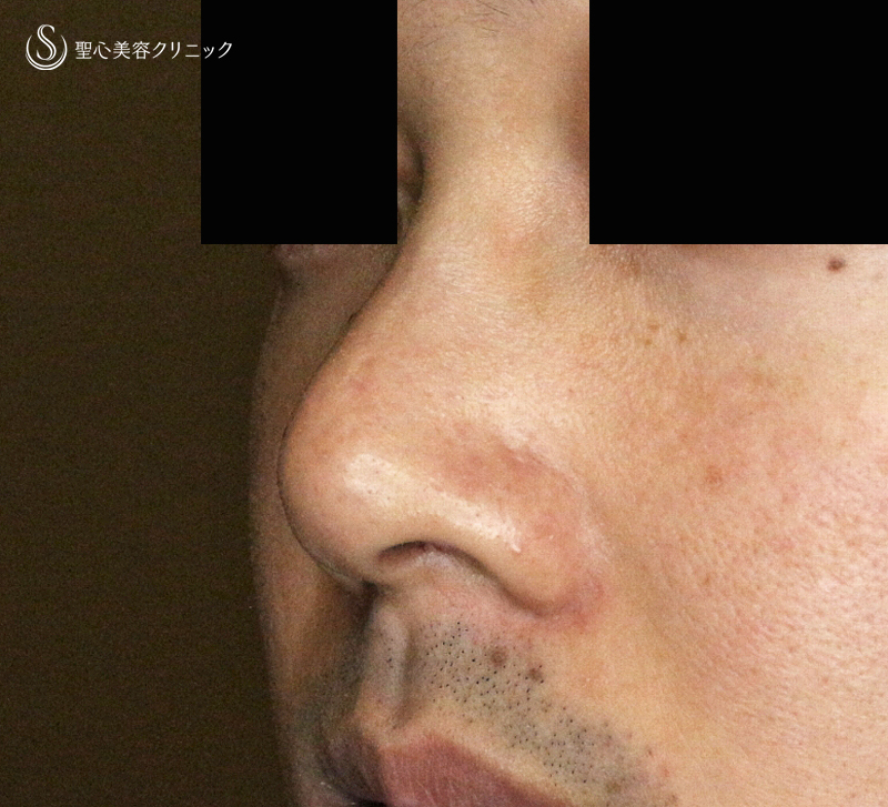 【20代男性・外側切開なしで「忘れ鼻」】小鼻縮小術+α法「Ver.7.5」単独（術直後〜7ヶ月後） Before 