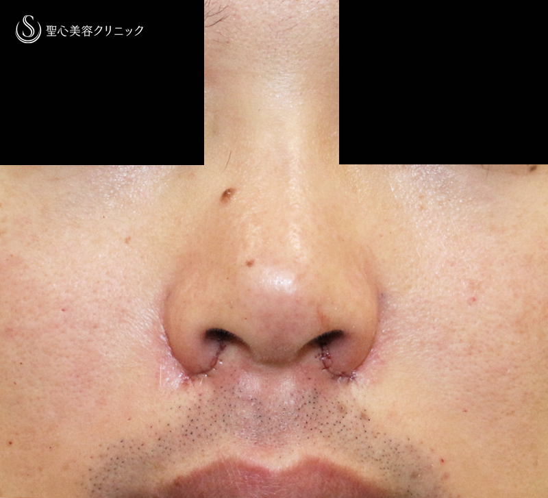 【20代男性・外側切開なしで「忘れ鼻」】小鼻縮小術+α法「Ver.7.5」単独（術直後〜7ヶ月後） Before 