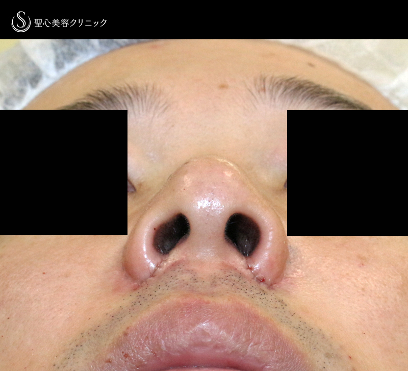 【20代男性・外側切開なしで「忘れ鼻」】小鼻縮小術+α法「Ver.7.5」単独（術直後〜7ヶ月後） Before 