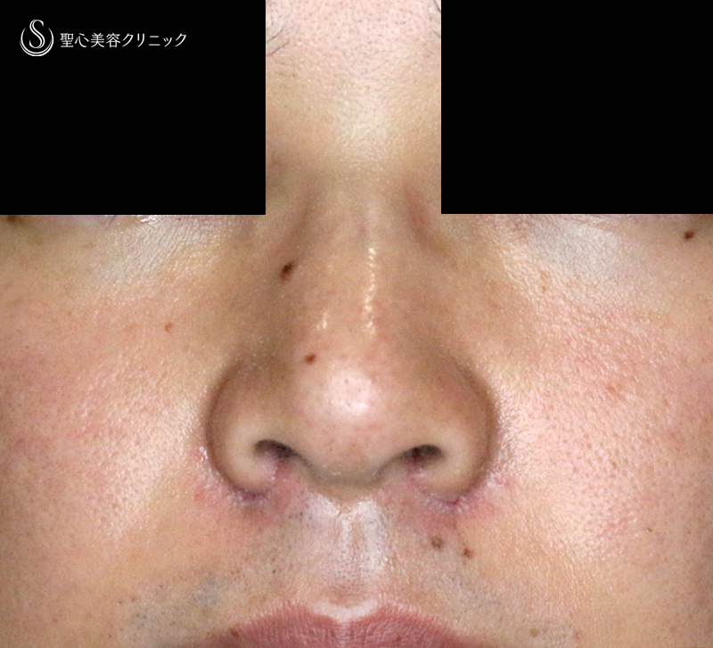 【20代男性・外側切開なしで「忘れ鼻」】小鼻縮小術+α法「Ver.7.5」単独（術直後〜7ヶ月後） After 