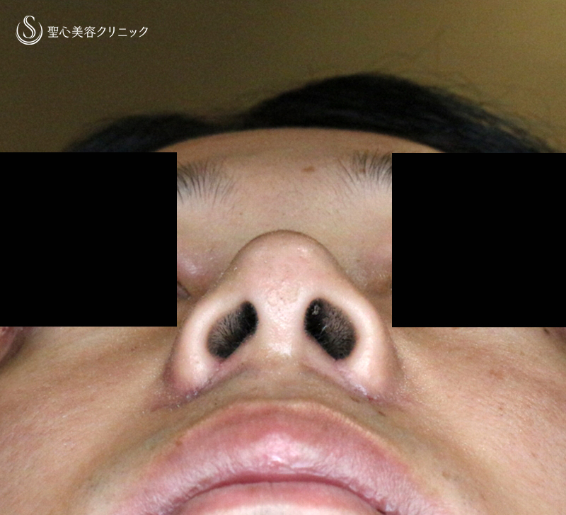 【20代男性・外側切開なしで「忘れ鼻」】小鼻縮小術+α法「Ver.7.5」単独（術直後〜7ヶ月後） After 