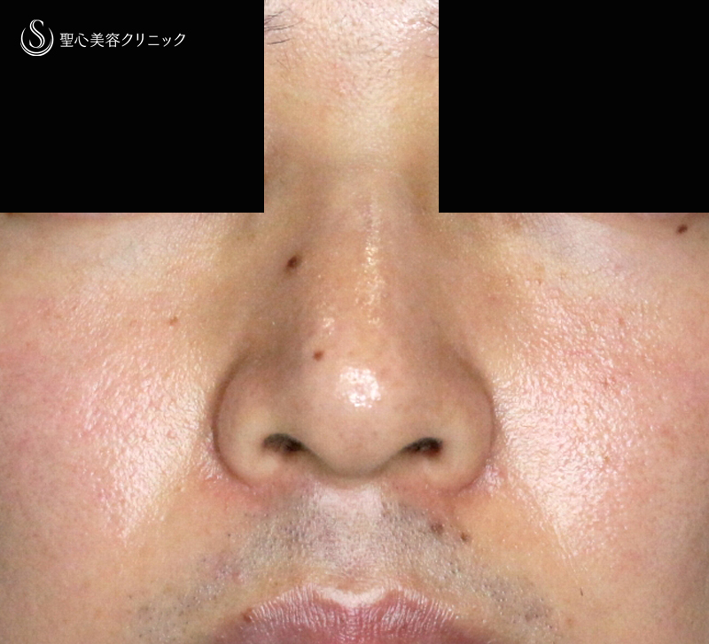 【20代男性・外側切開なしで「忘れ鼻」】小鼻縮小術+α法「Ver.7.5」単独（術直後〜7ヶ月後） After 