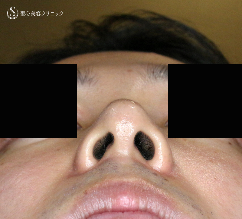 【20代男性・外側切開なしで「忘れ鼻」】小鼻縮小術+α法「Ver.7.5」単独（術直後〜7ヶ月後） After 
