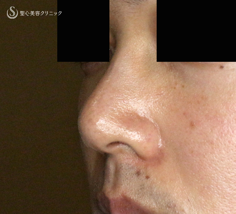 【20代男性・外側切開なしで「忘れ鼻」】小鼻縮小術+α法「Ver.7.5」単独（術直後〜7ヶ月後） After 