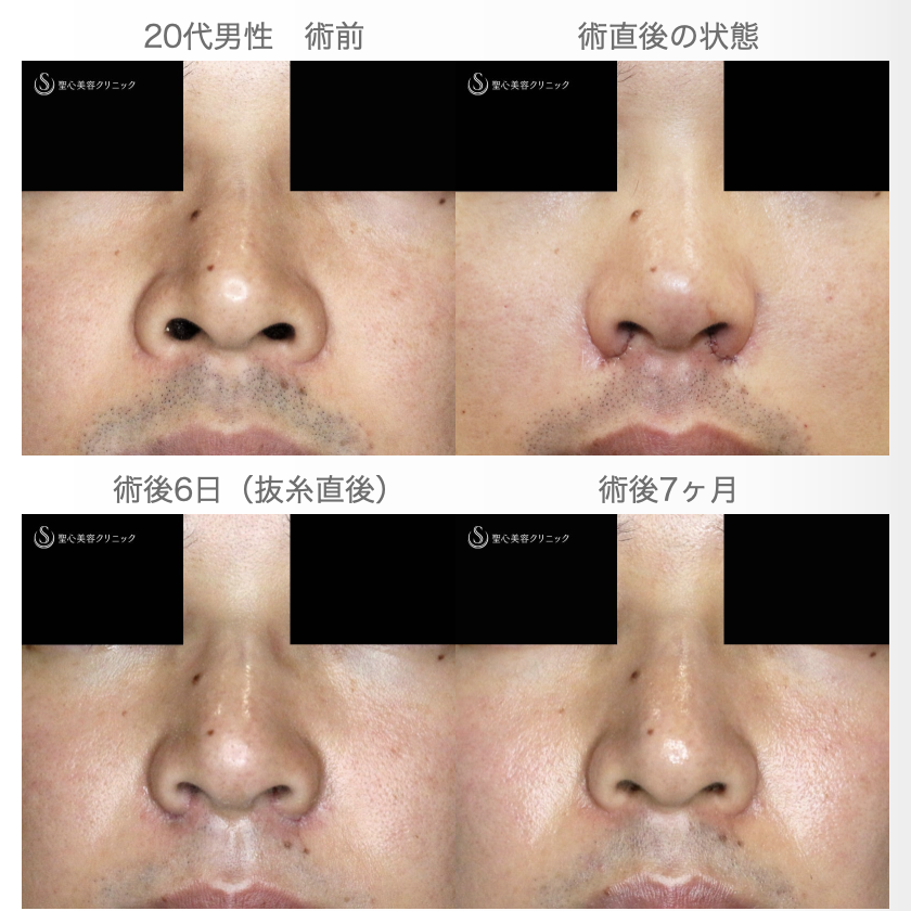【20代男性・外側切開なしで「忘れ鼻」】小鼻縮小術+α法「Ver.7.5」単独（術直後〜7ヶ月後） Before 