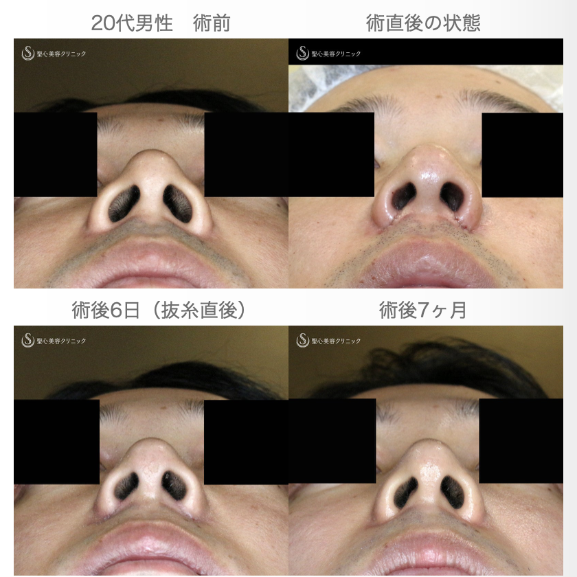 【20代男性・外側切開なしで「忘れ鼻」】小鼻縮小術+α法「Ver.7.5」単独（術直後〜7ヶ月後） After 